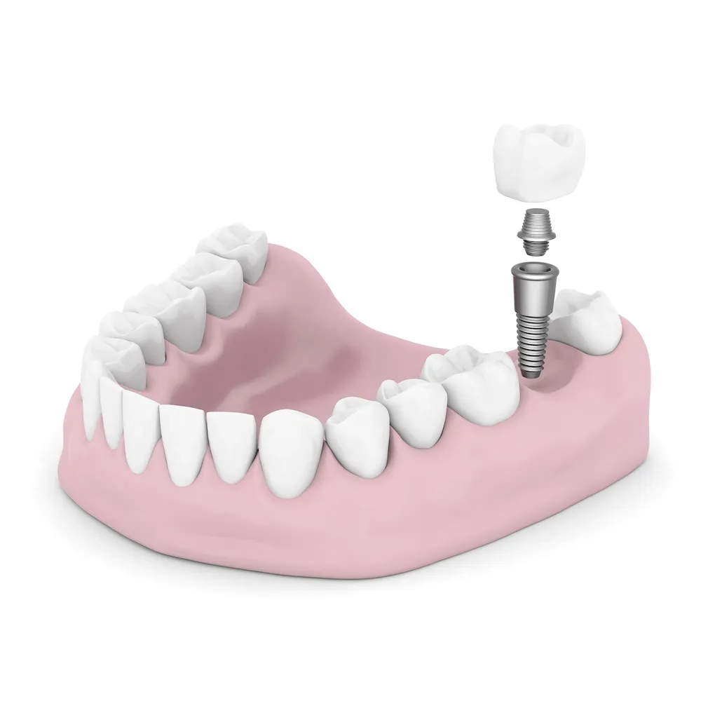 Dental Implant Consultation  